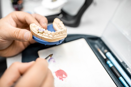 Prothèse dentaire 3D